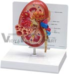 Oversize Diseased Kidney Anatomy Model with Patient Education Card